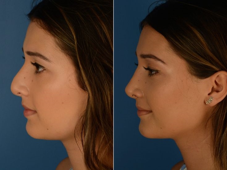 rhinoplasty surgeons