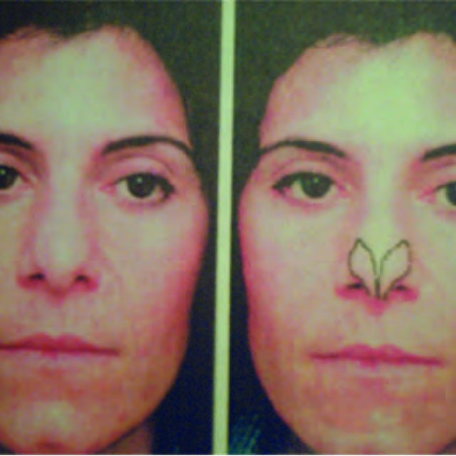 rhinoplasty surgeons