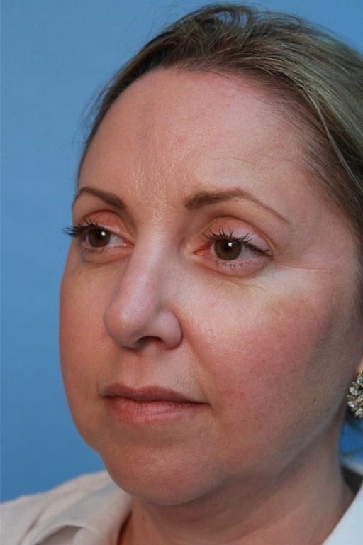 rhinoplasty surgeons